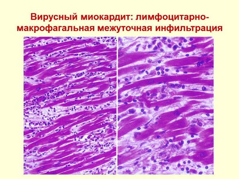 Вирусный миокардит: лимфоцитарно-макрофагальная межуточная инфильтрация